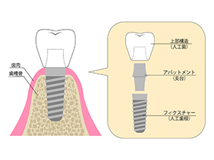 インプラントの構造について